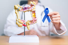 especialista colon recto y ano en Mérida explica como prevenir el cancer colorrectal