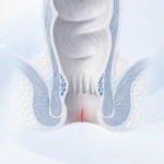 Ilustración médica de una fisura anal localizada en el canal anal