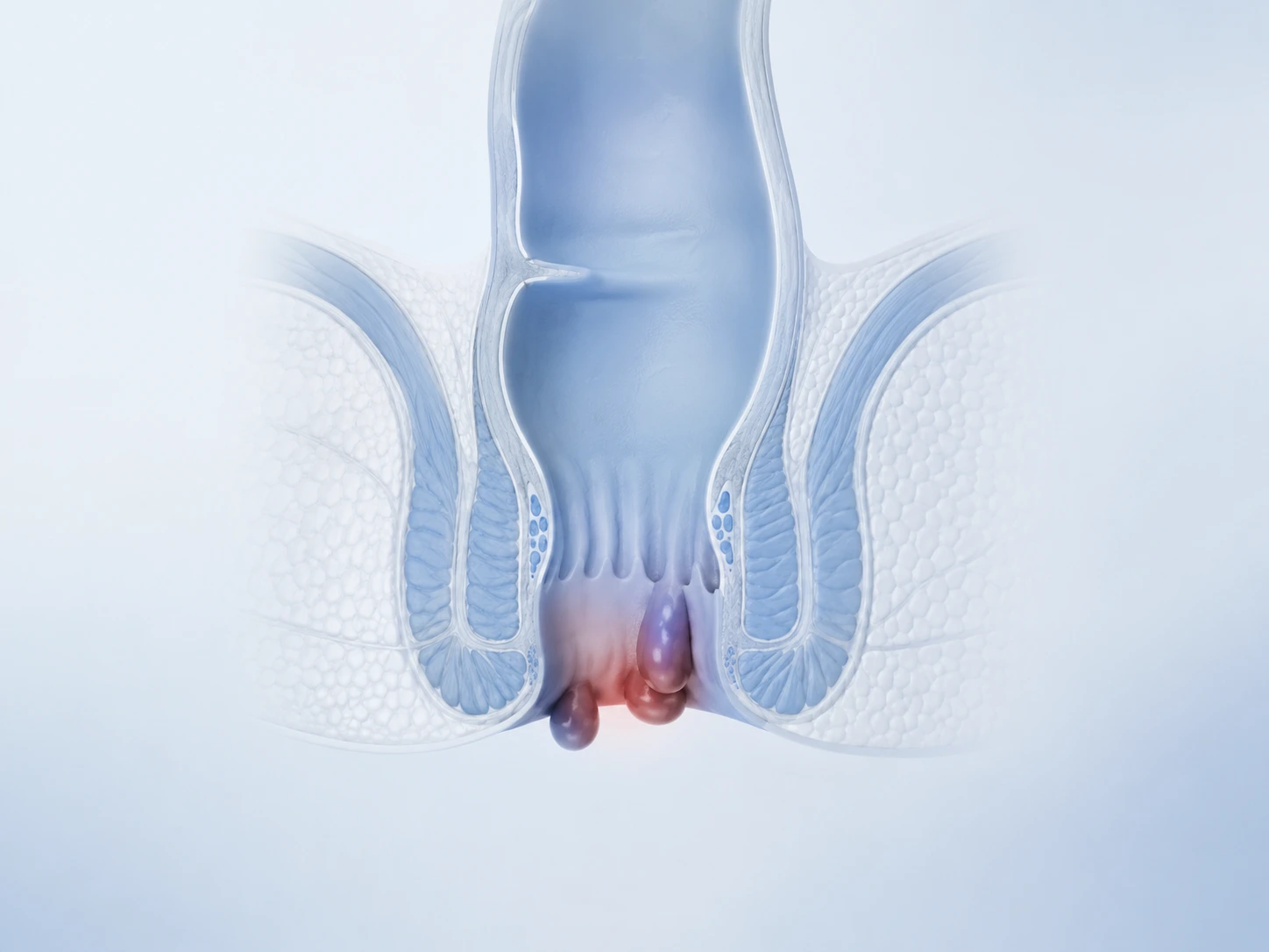 Ilustración médica de hemorroides internas y externas en el canal anal
